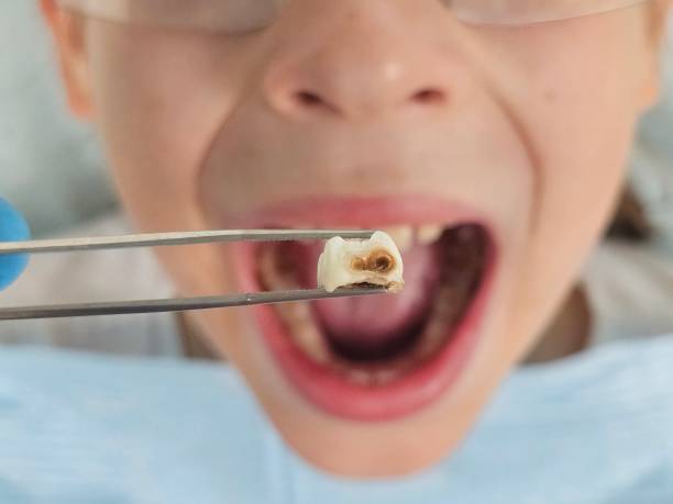 Best Emergency Dental Extractions in Sterling City, TX